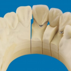 Μέταλλο-πορσελάνη δόντια